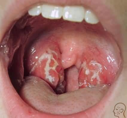Грибок в горле: причины, симптомы и лечение заболевания